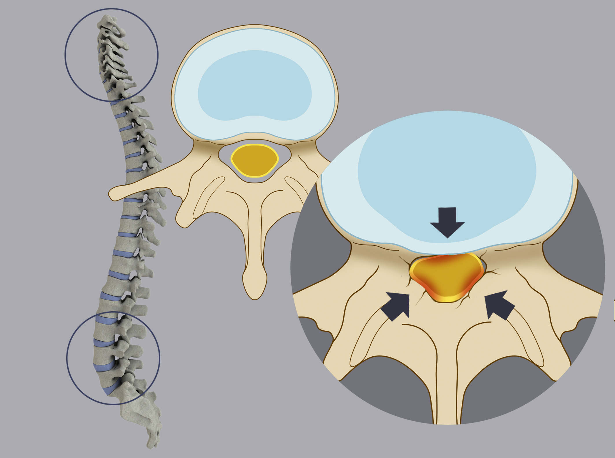  Stenosis is a narrowing of the spinal canal, so that nerve roots and/or spinal cord are compressed.