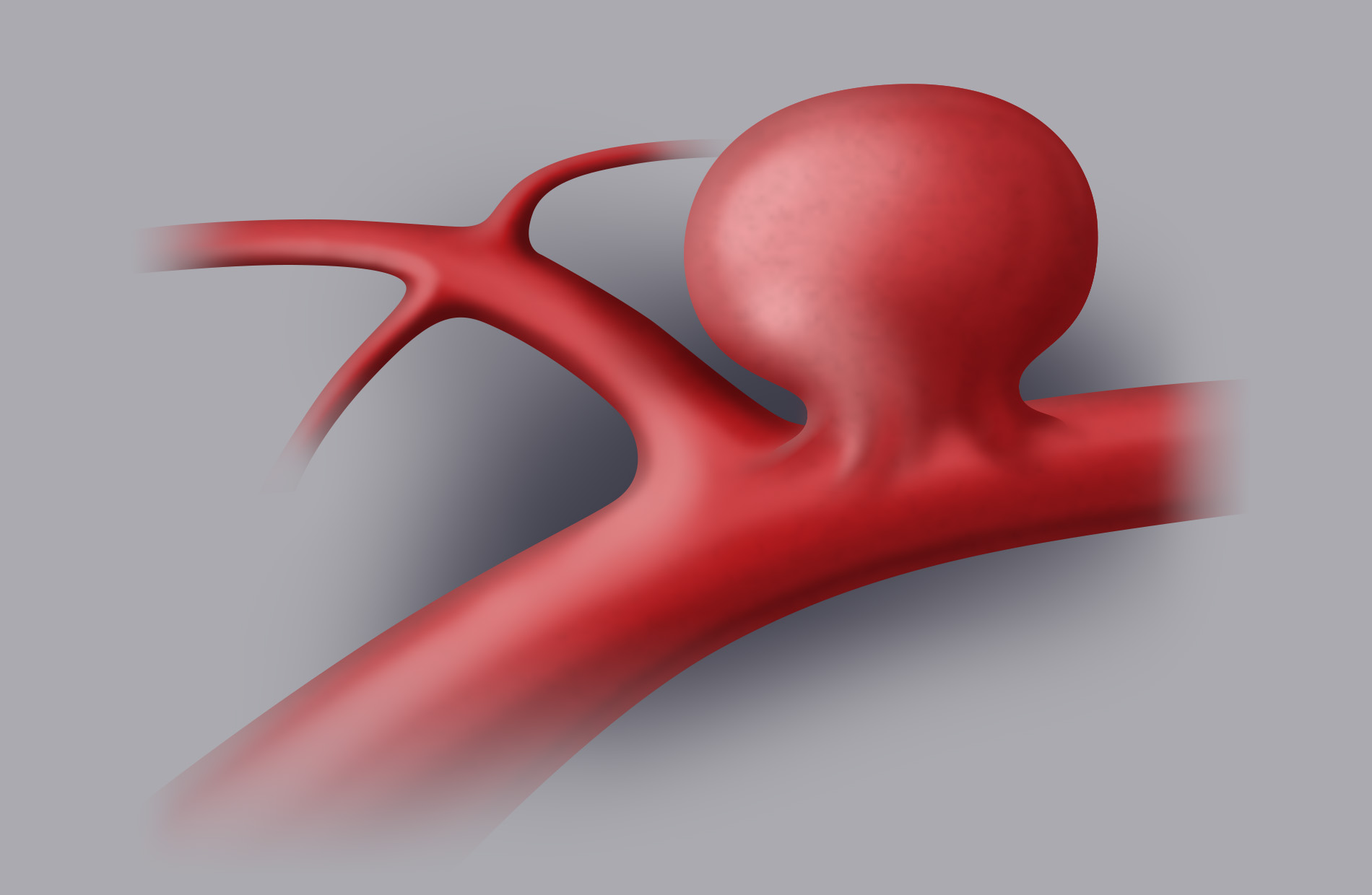 The aneurysm is a ballon-shaped arterial bulging; it is usually located where arteries bifurcate