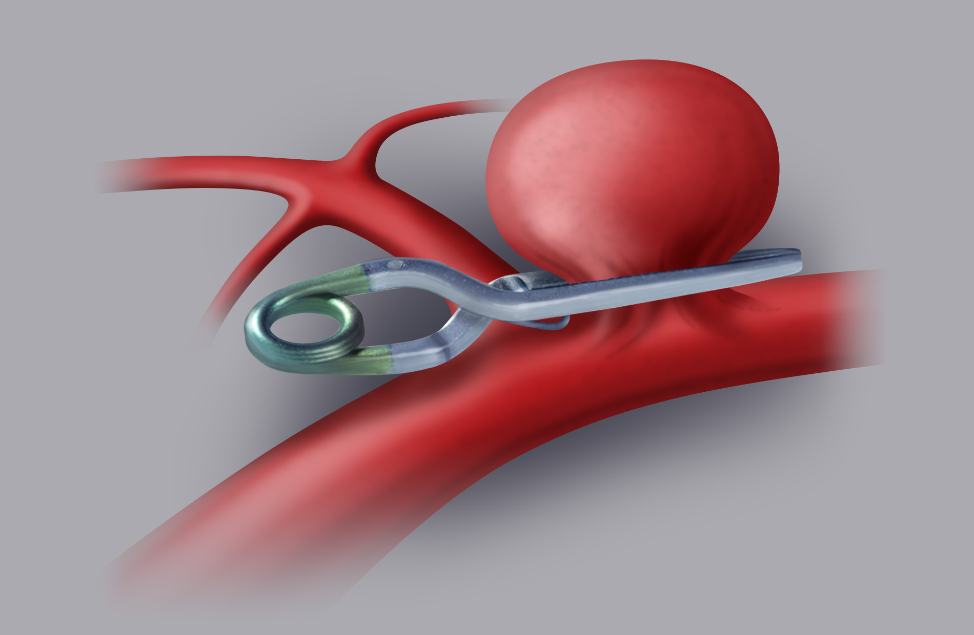 Surgical treatment (clipping). The aneurysm is excluded from cerebral circulation by applying one  or more clips (small titanium clips) on the neck of the aneurysm.