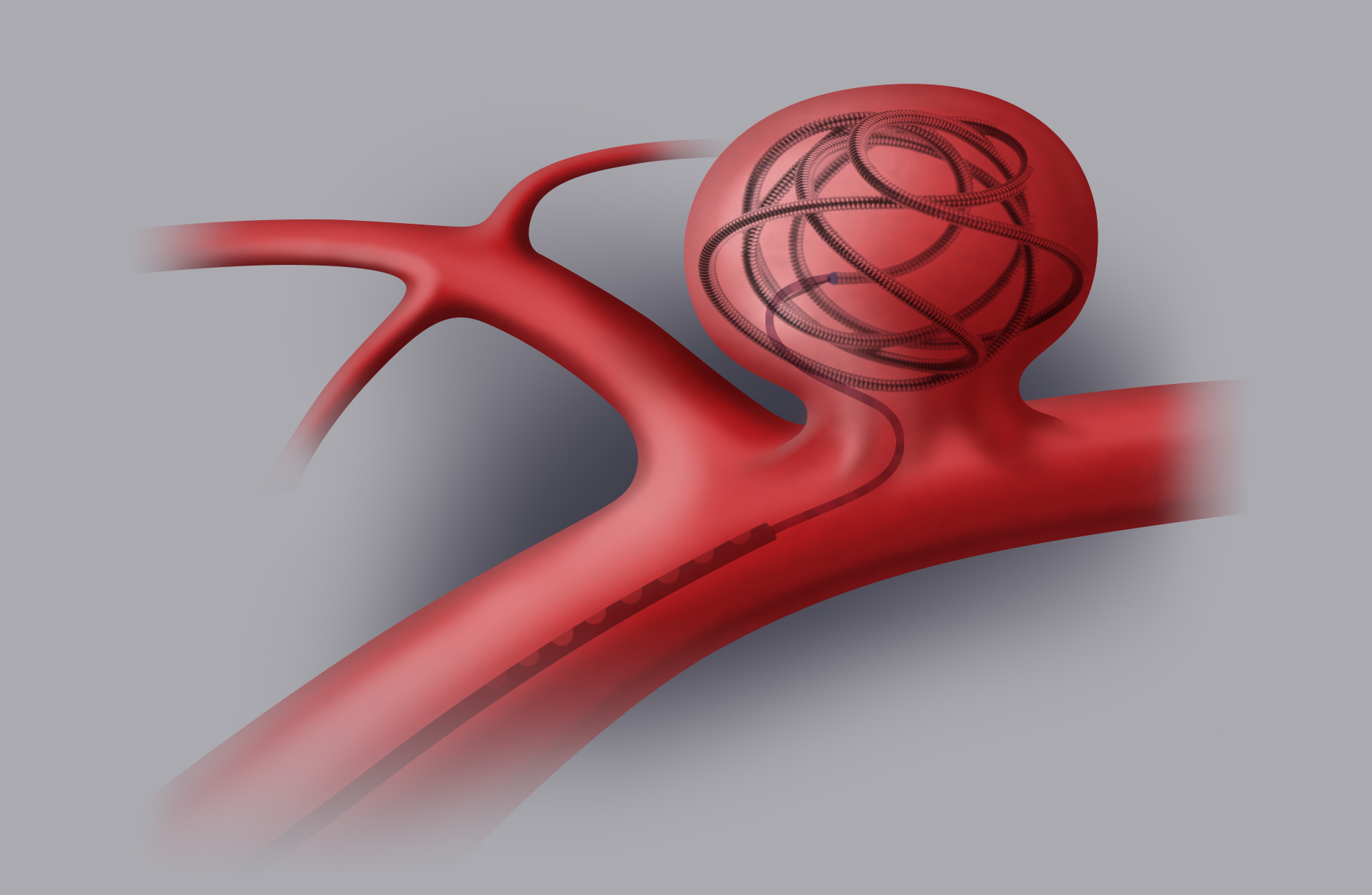 Trattamento endovascolare (coiling-stenting). Tramite introduzione di un microcatetere e sotto guida angiografica vengono rilasciate delle micro spirali (coils) all’interno dell’aneurisma. 