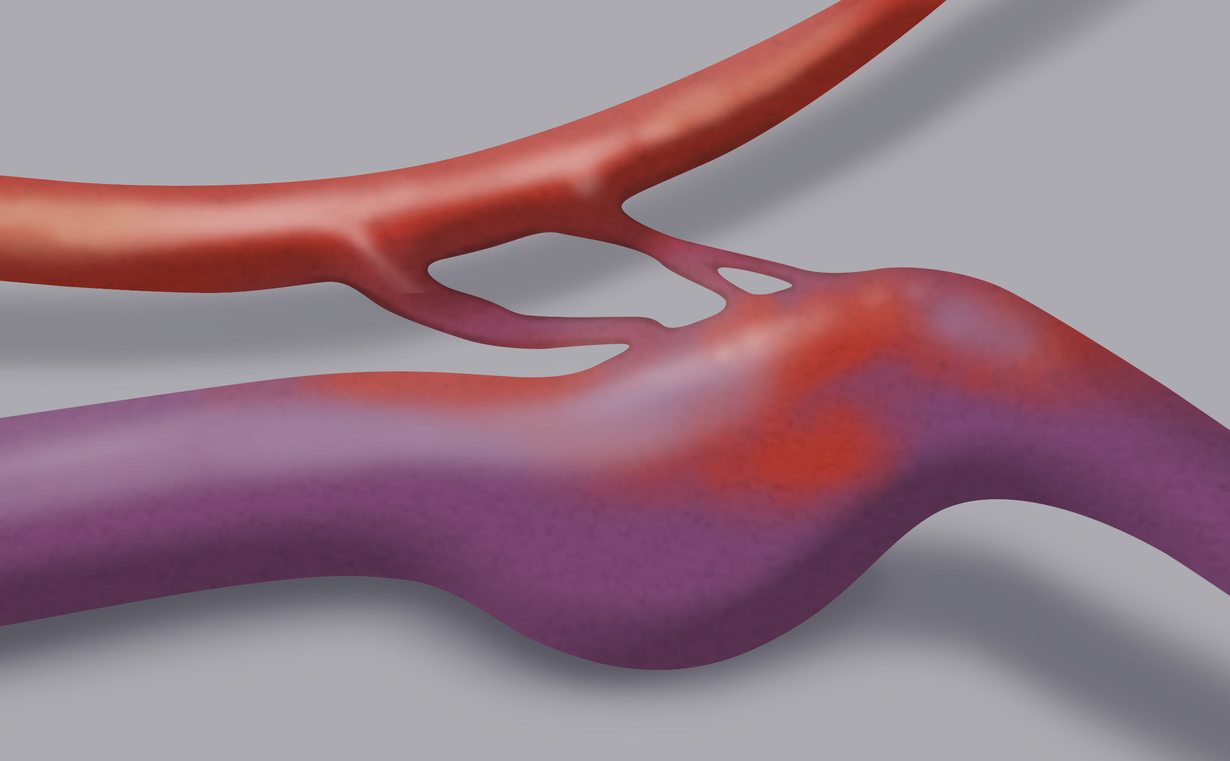 La fistola artero-venosa è una malformazione vascolare costituita da un’anomala comunicazione tra un’arteria e una vena: tale passaggio è diretto, senza interposizione di capillari. Il disegno mostra chiaramente la forte dilatazione del vaso venoso.