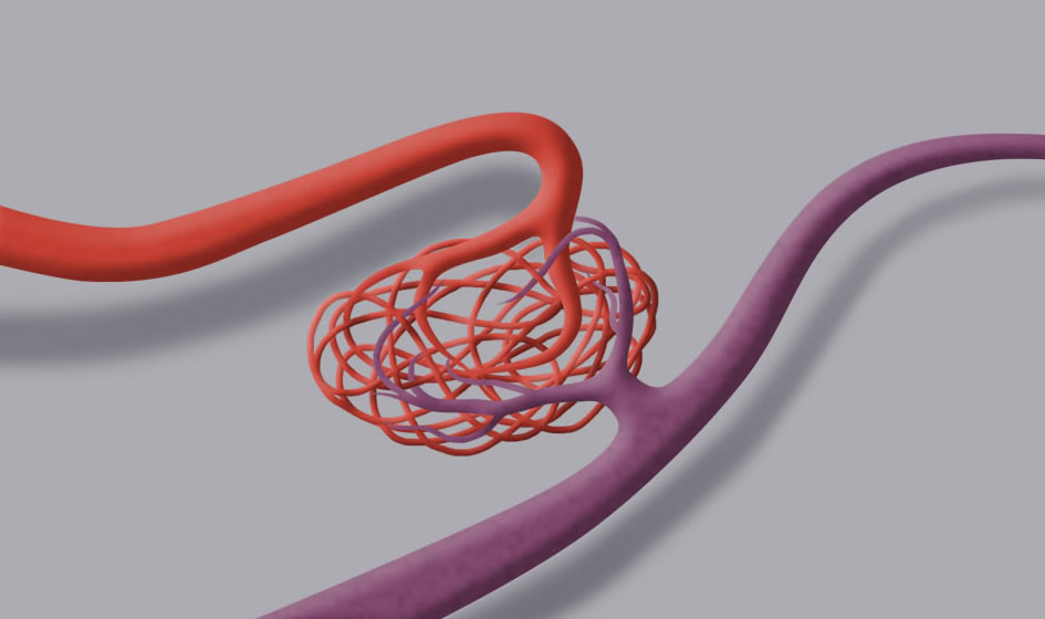 Il disegno mostra la formazione di un gomitolo di vasi arteriosi patologici, il nidus; da qui, il sangue viene convogliato nello scarico venoso.