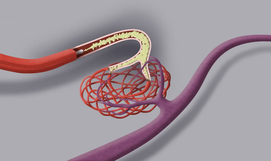 Trattamento endovascolare. Per mezzo dell'introduzione di un microcatetere vengono iniettati polimeri con lo scopo di ridurre progressivamente il flusso all'interno del nidus.