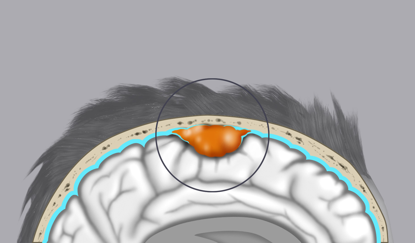 Il disegno mostra un meningioma della convessità: il tumore origina dalle meningi che rivestono l’encefalo.