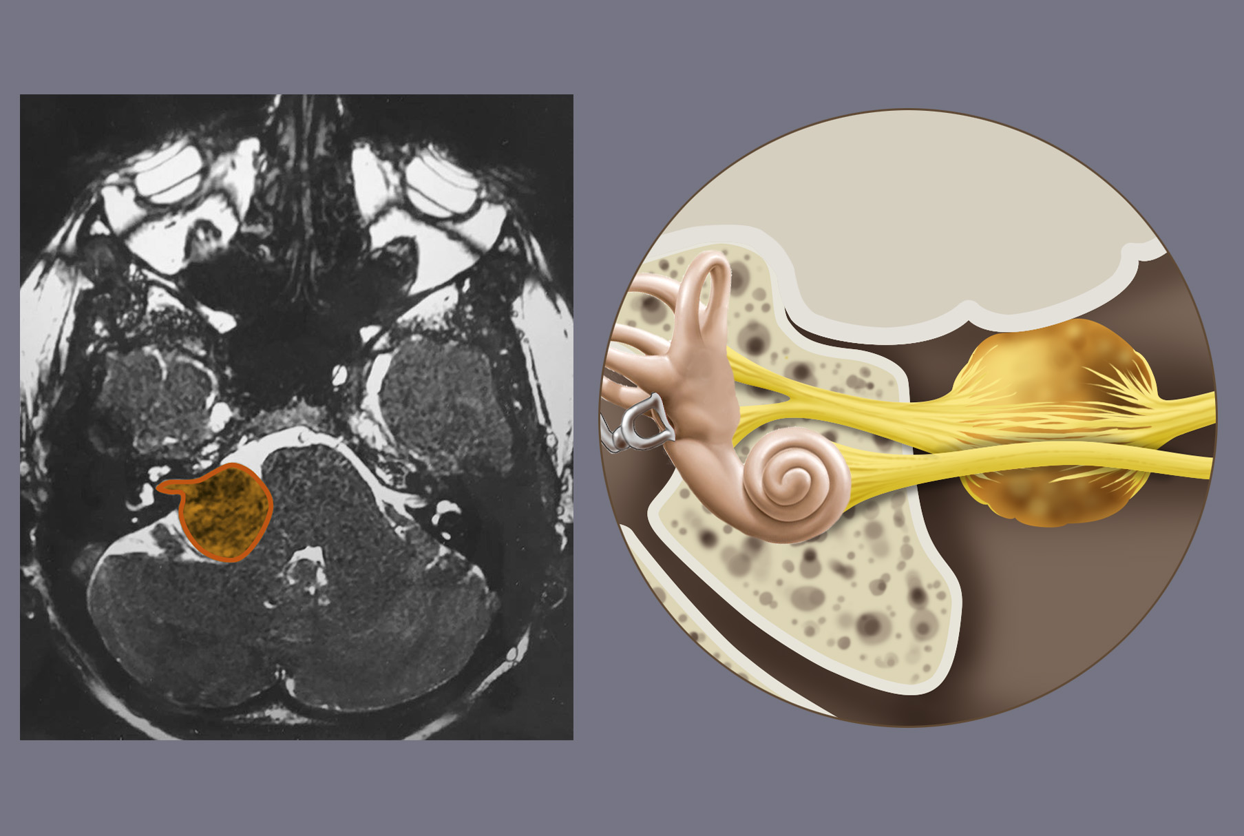 The acoustic neuroma is a benign slow-growing tumor originating from the vestibular nerve  in the internal auditory meatus. As you can see, it can reach a considerable size
