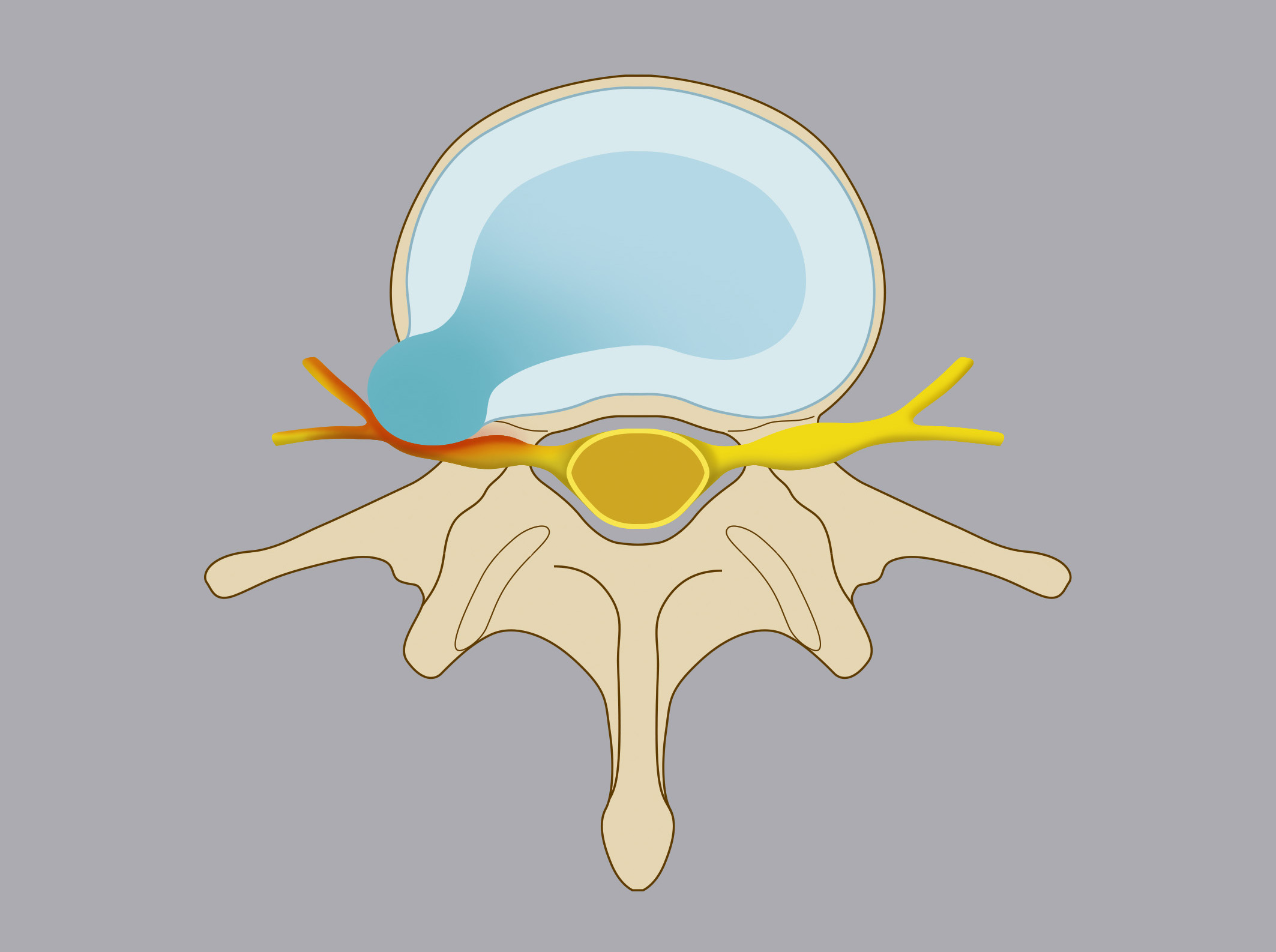 Extraforaminal herniation. The nucleus pulposus spills laterally to the intervertebral foramina
