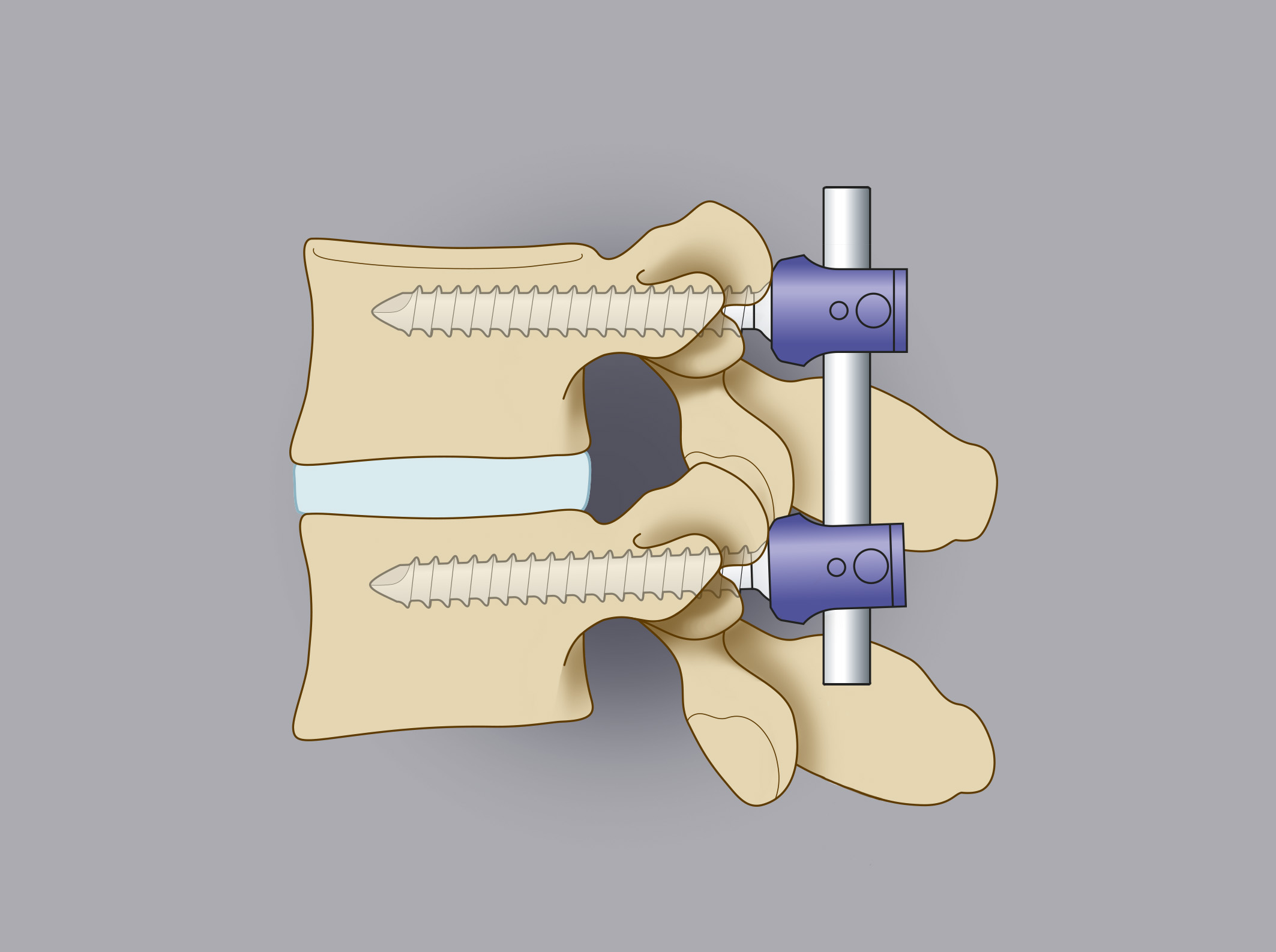 Trattamento chirurgico delle ernie lombari. In alcuni casi, in associazione alla rimozione del frammento erniario, è utile procedere a una stabilizzazione vertebrale. Il disegno mostra l’utilizzo di viti peduncolari.