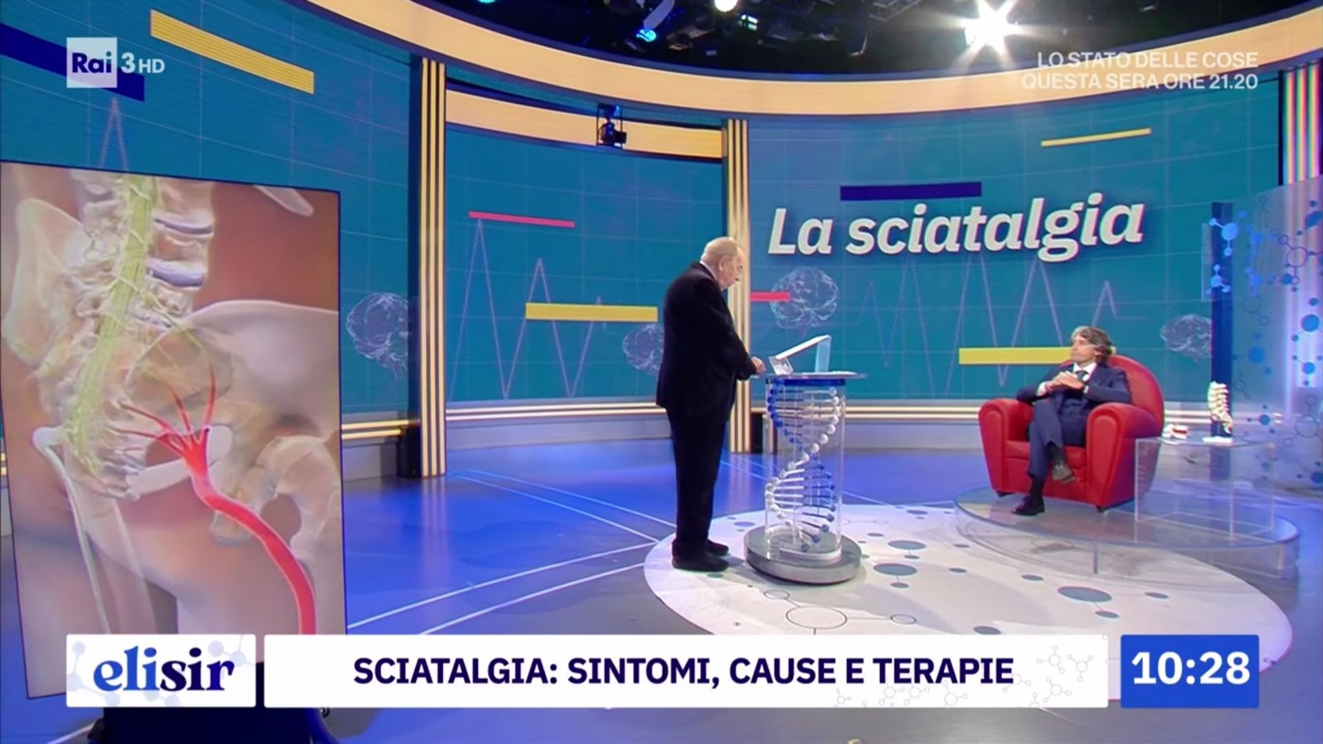 sciatalgia